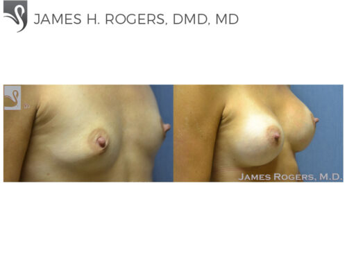 Breast Augmentation Case #50333 (Image 2)
