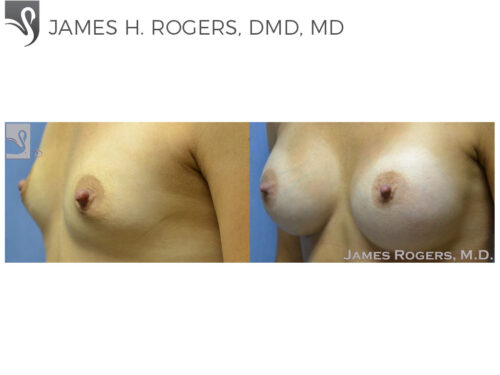 Breast Augmentation Case #50333 (Image 3)