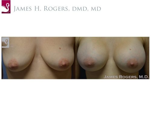 Breast Augmentation Case #50465 (Image 1)