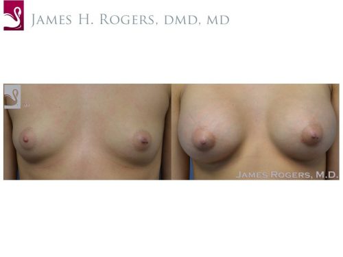 Breast Augmentation Case #50636 (Image 1)