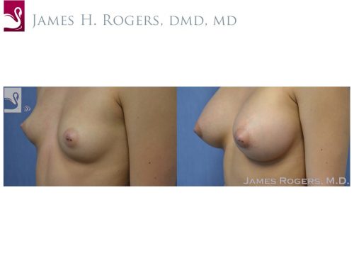 Breast Augmentation Case #50636 (Image 3)