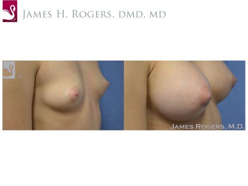 Breast Augmentation Case #50636 (Image 2)