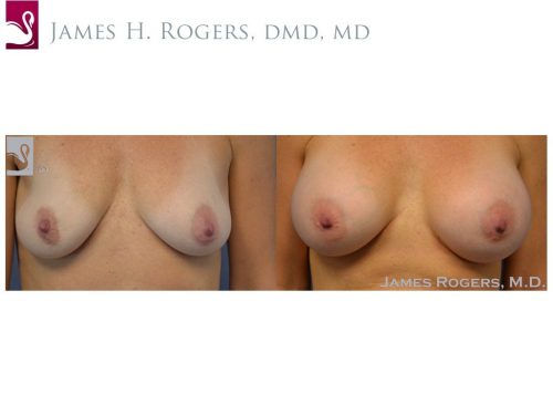 Breast Augmentation Case #51001 (Image 1)