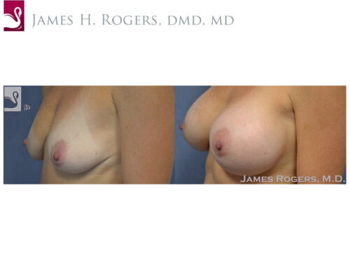 Breast Augmentation Case #51001 (Image 3)