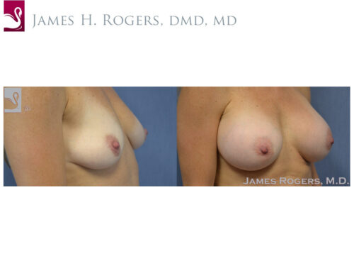 Breast Augmentation Case #51001 (Image 2)