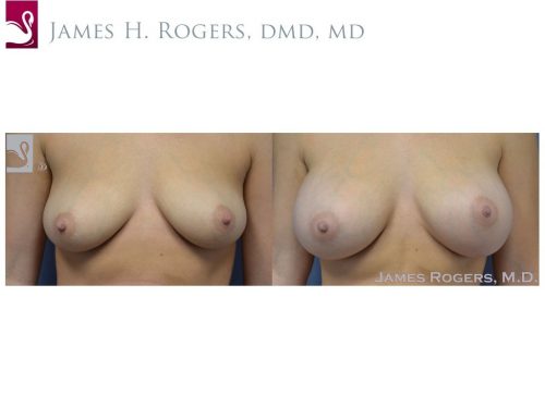 Breast Augmentation Case #51333 (Image 1)