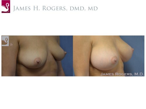 Breast Augmentation Case #51333 (Image 2)