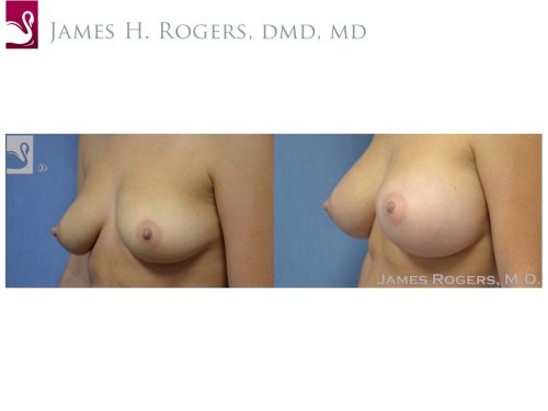 Breast Augmentation Case #51333 (Image 3)