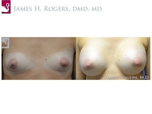 Breast Augmentation Case #51607 (Image 1)