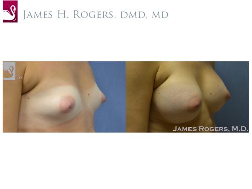 Breast Augmentation Case #51607 (Image 2)