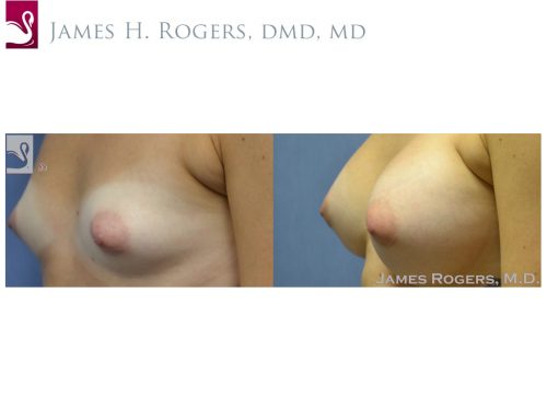 Breast Augmentation Case #51607 (Image 3)