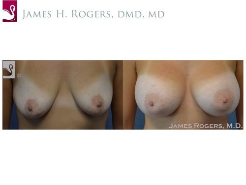 Breast Augmentation Case #51706 (Image 1)