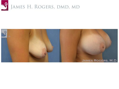 Breast Augmentation Case #51706 (Image 2)