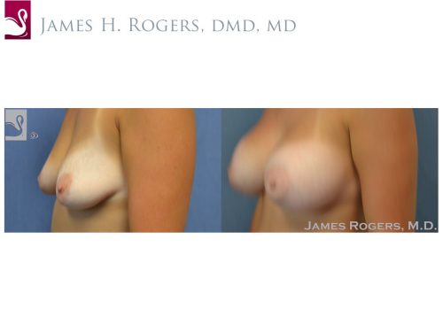 Breast Augmentation Case #51706 (Image 3)