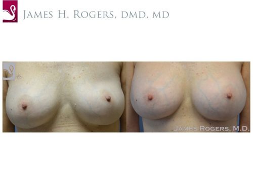 Breast Revisions Case #51781 (Image 1)
