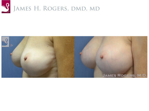 Breast Revisions Case #51781 (Image 3)