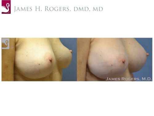 Breast Revisions Case #51781 (Image 2)