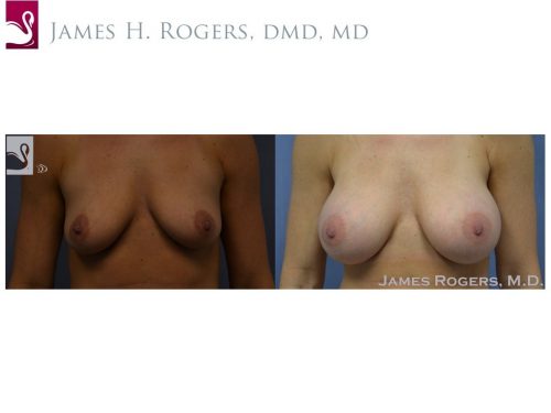 Breast Augmentation Case #51975 (Image 1)