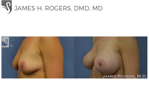 Breast Augmentation Case #51975 (Image 3)