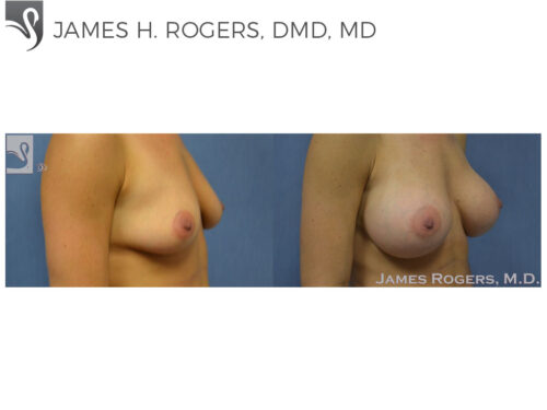 Breast Augmentation Case #51975 (Image 2)