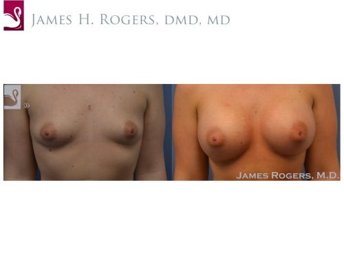 Breast Augmentation Case #52613 (Image 1)