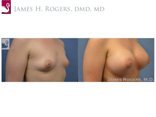 Breast Augmentation Case #52613 (Image 2)