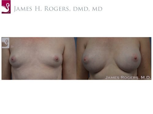 Breast Augmentation Case #53088 (Image 1)
