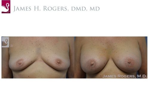 Breast Augmentation Case #53314 (Image 1)