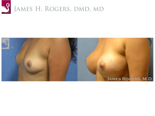 Breast Augmentation Case #53744 (Image 3)