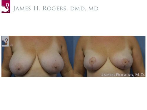 Female Breast Reduction Case #53843 (Image 1)