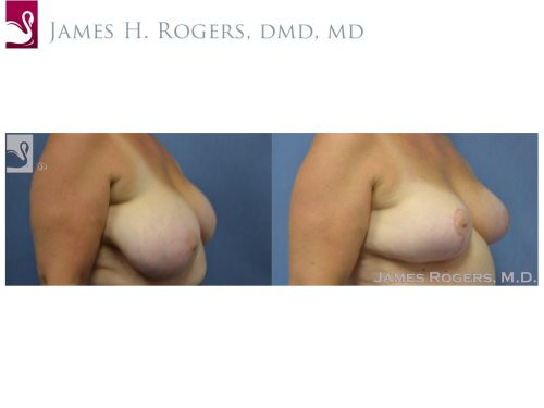 Female Breast Reduction Case #53843 (Image 2)