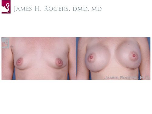 Breast Augmentation Case #54396 (Image 1)