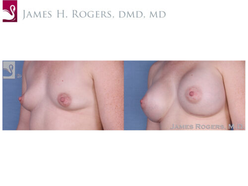 Breast Augmentation Case #54396 (Image 2)
