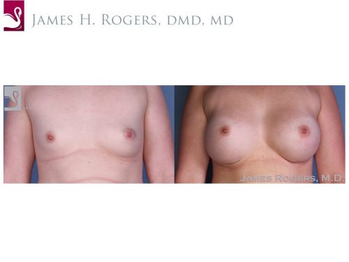 Breast Augmentation Case #54860 (Image 1)