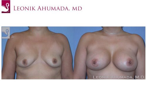 Breast Augmentation Case #37241 (Image 1)