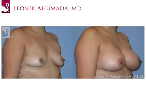 Breast Augmentation Case #37241 (Image 2)