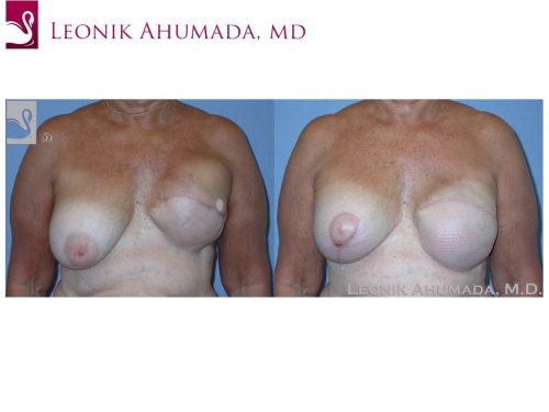 Breast Reconstruction Case #39226 (Image 1)