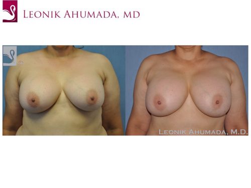 Breast Revisions Case #44722 (Image 1)