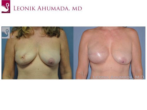 Breast Reconstruction Case #46515 (Image 1)