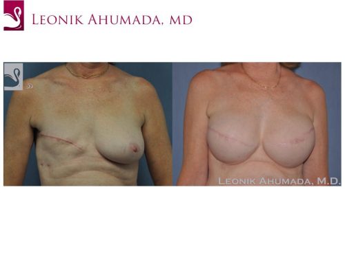 Breast Reconstruction Case #46673 (Image 1)