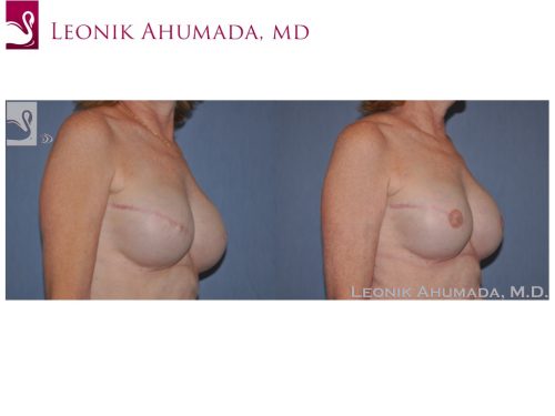 Breast Reconstruction Case #46673 (Image 2)