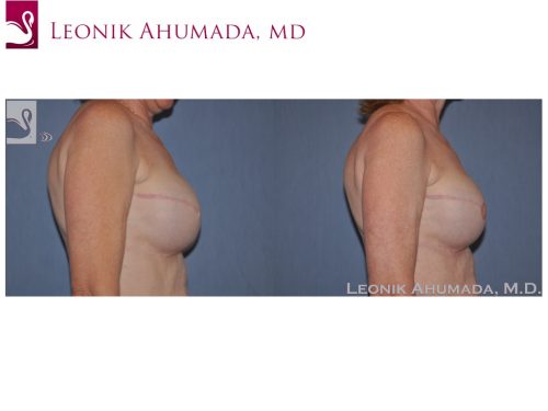 Breast Reconstruction Case #46673 (Image 3)