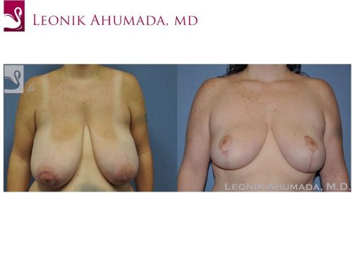 Female Breast Reduction Case #48951 (Image 1)