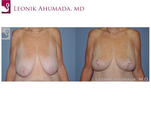 Female Breast Reduction Case #49642 (Image 1)