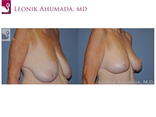 Female Breast Reduction Case #49642 (Image 2)
