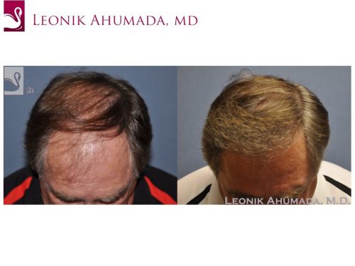 Hair Transplant Case #49968 (Image 1)