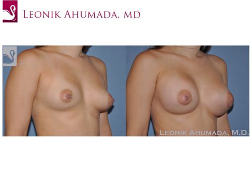 Breast Augmentation Case #51499 (Image 2)