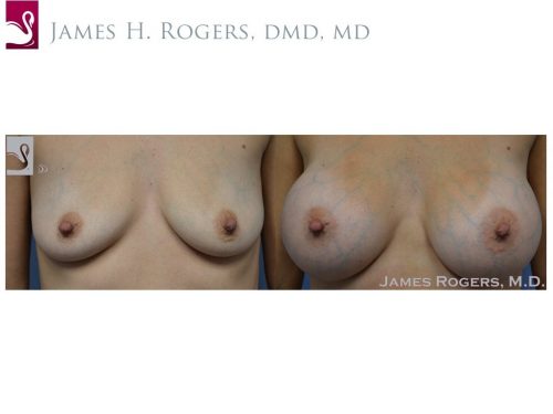 Breast Augmentation Case #28286 (Image 1)