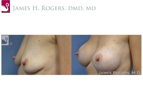 Breast Augmentation Case #28286 (Image 3)