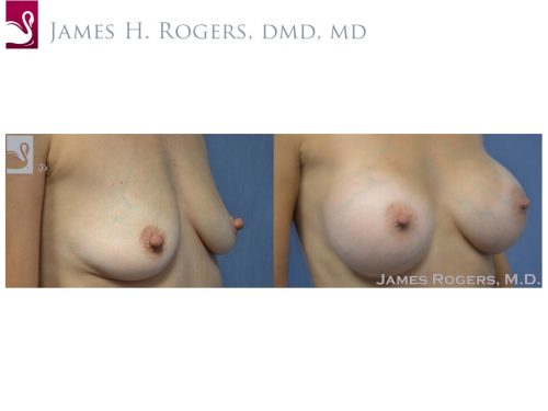 Breast Augmentation Case #28286 (Image 2)
